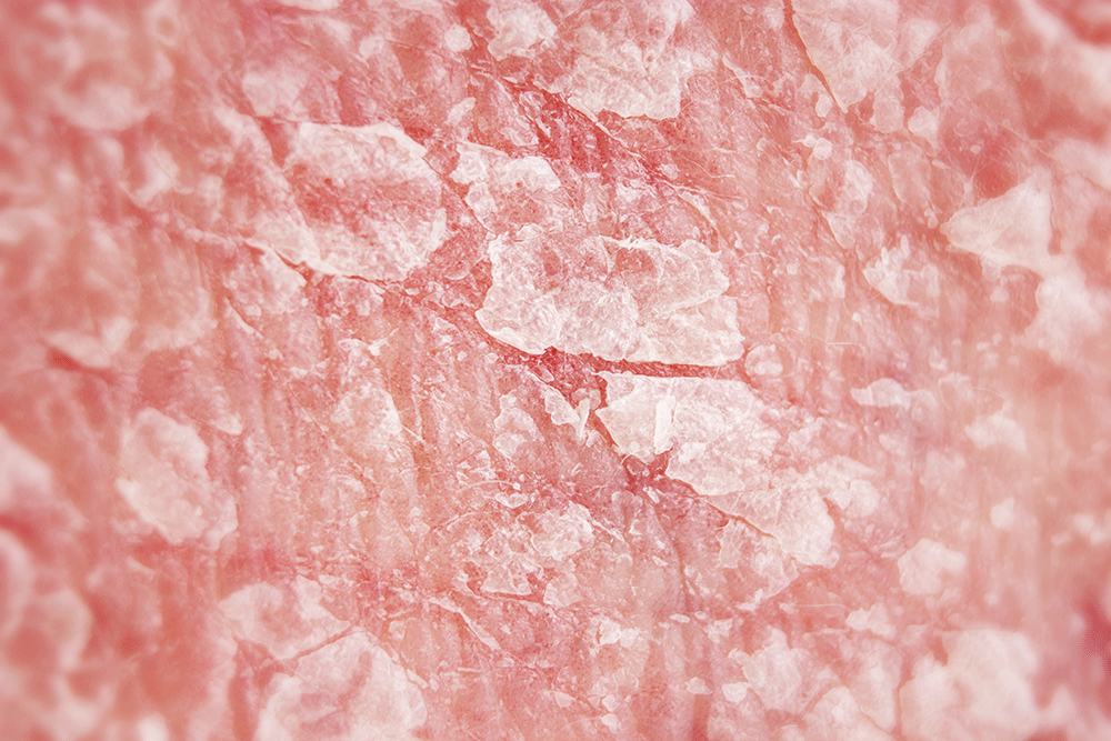 Traitement pour soigner la dermatite sur peau atopique, l'eczema atopique